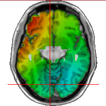  Your Guide to LORETA Neurofeedback: Consulting & Support for Clinics